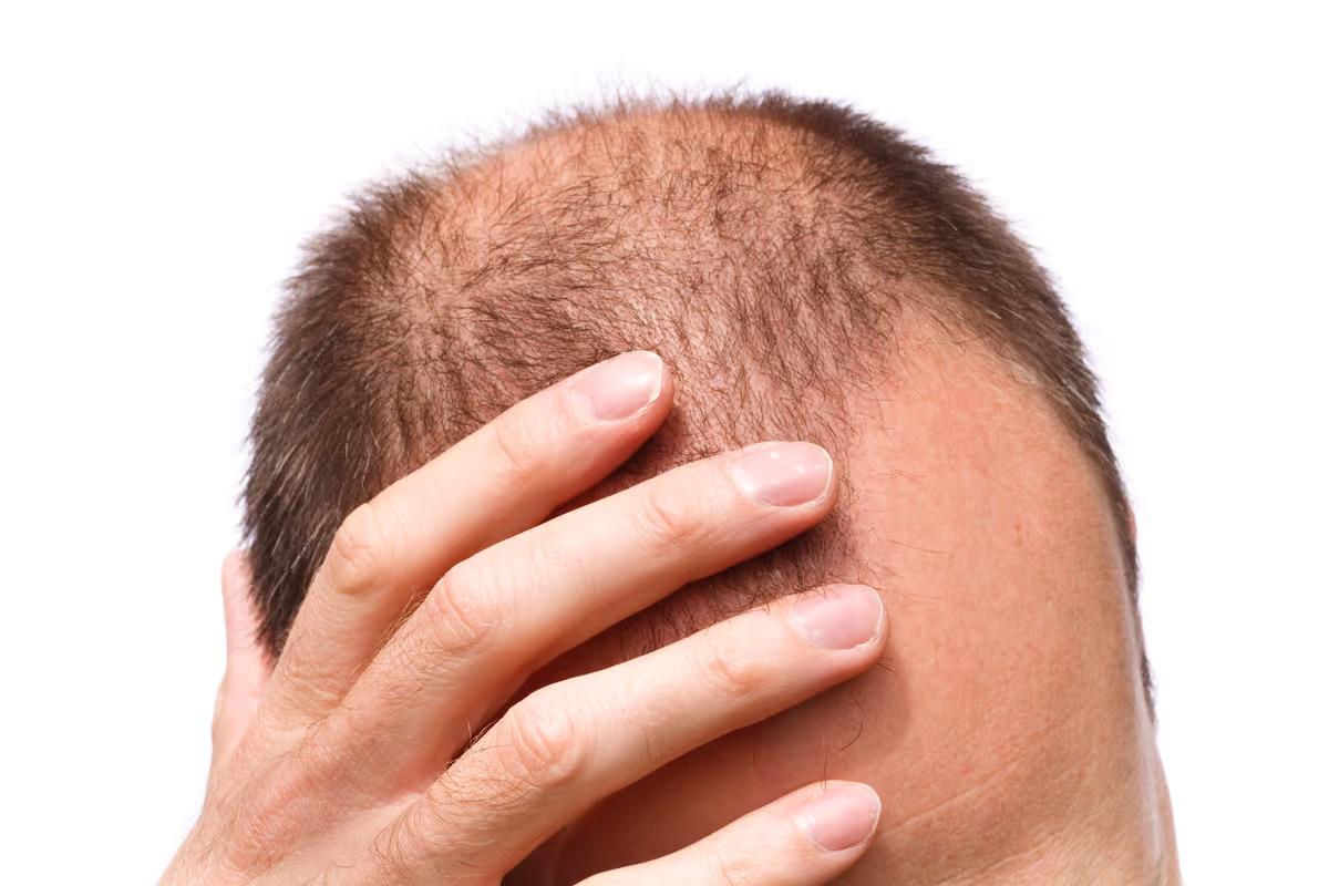Stem Cell Injections for Hairloss in Chandigarh